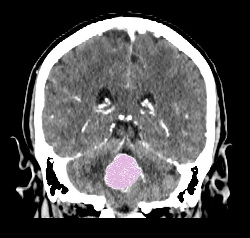 I Have a Brain Tumor